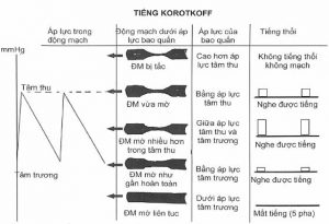 Mối liên quan giữa áp lực trong bao quấn máy đo với tiếng Korotkoff và áp lực động mạch